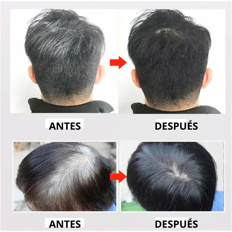 💎SHAMPOO ANTICANAS UNISEX👌😍